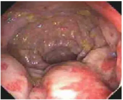 Gambar 1.2 Prochitis