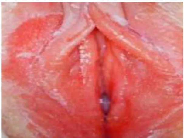 Gambar 1.3 VULVITIS