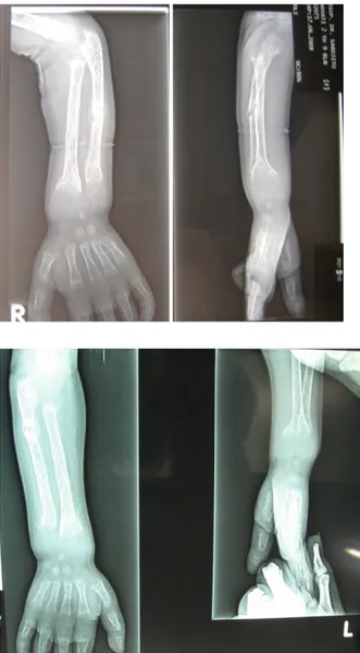 Gambar 5. Foto antebrachii dan wrist joint dextra dan sinistra.