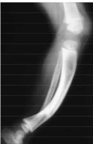 Gambar 14. Kasus rickets yang telah diterapi dengan gambaran sisa deformitas lengkung.