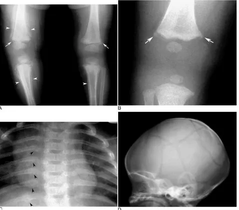 Gambar 19. Gambaran non accidental injury. Gambar A dan B memperlihatkan classic metaphyseal lesions (CML), yang disertai gambaran pembentukan periosteal tulang baru dengan derajat maturitas yang berbeda-beda, mencerminkan fraktur multipel dengan umur yang