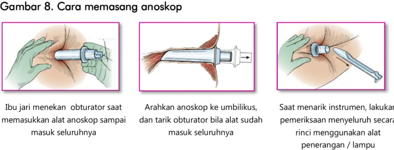 Gambar 8. Cara memasang anoskop 