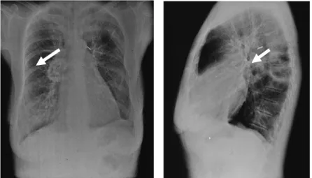 Gambar 4. Foto X-Ray ini ditemukan kavitas pada hilum kanan. Foto  X-ray posisi lateral memperlihatkan kavitas memiliki dinding yang  tipis dan terletak pada segmen apikal dari lobus paru kanan bawah