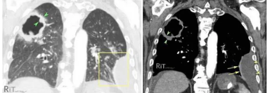Gambar 10. Potongan coronal dada pada gambar CT menunjukkan adanya  lesi pada lobus atas kanan dengan internal air-filled cavity, dinding tebal  tidak beraturan (panah warna hijau) dan lesi lain di sebelah bawah  paru kiri 