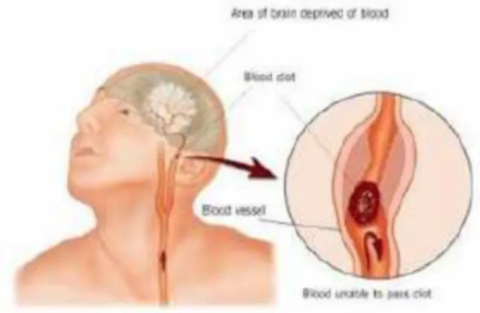 Gambar 6. Stroke