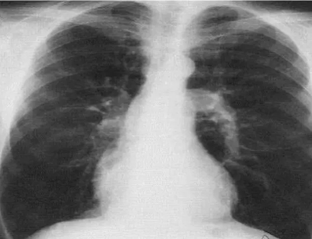 Gambar  paru-paru  terserang  TBC,  terbentuk  sarang  akibat  proses  fibrosis  pada  paru-paru 
