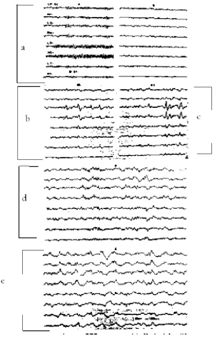 Figure 6. Normal EEG patterns: (a) alert state, (b) drowsiness, (c) theta and beta waves, (d) moderately deep sleep (e) deep sleep.