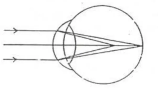 Gambar 4. Simple Miop Astigmat 