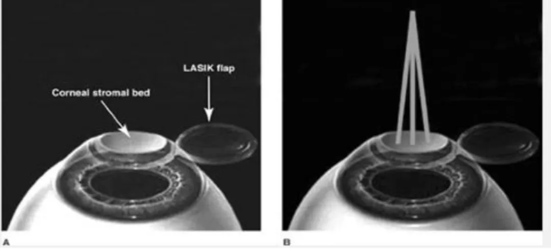Gambar 12. Operasi LASIK 