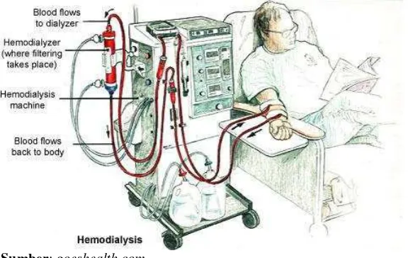 Gambar 4. Mekanisme hemodialisis 
