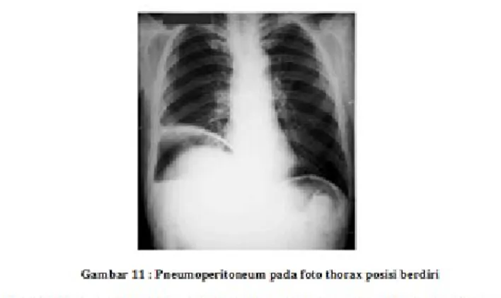 Foto harus dilihat ada tidaknya udara bebas. Gas harus dievaluasi dengan  memperhatikan pola, lokasi dan jumlah udara di usus besar dan usus halus  (Cole et al,1970).