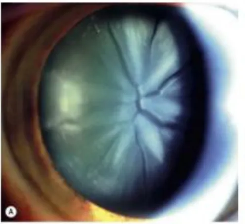 Gambar 6. Katarak traumatik (Flower-shaped cataract). 