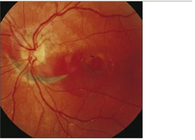 Gambar 8. Ruptur koroid  Dikutip dari kepustakaan No.9 