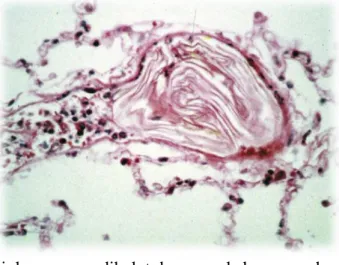 Gambar 1. Arteriol paru yang dibalut dengan sel skuamosa dan beberapa puing  inflamasi 3 