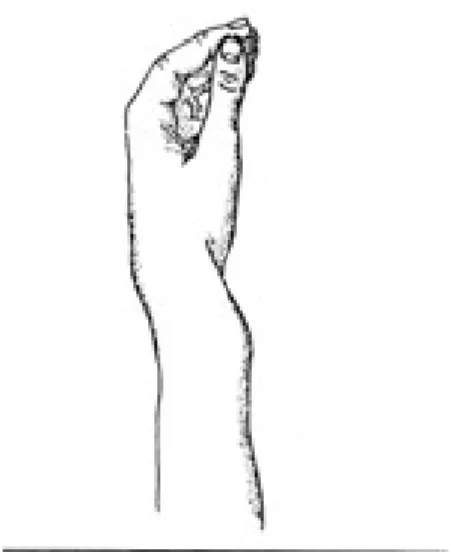 Gambar 2.5. Dinner fork deformity