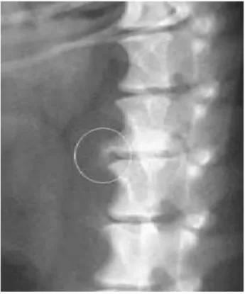 Gambar 9. Osteofit atau bone spur formation