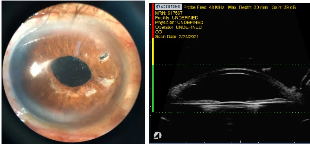 Gambar 2.3. Foto klinis dan UBM mata kanan (POD 3 minggu) 