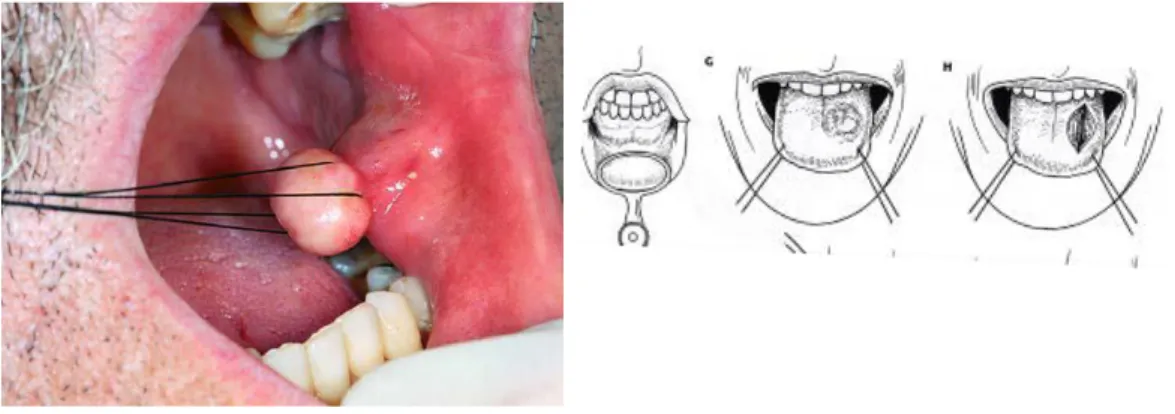 Gambar 3. Stabilisasi jaringan. Kiri: dengan retractin suture, kanan: dengan tang 