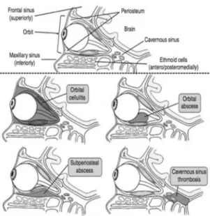Gambar 2. Komplikasi Orbita 21