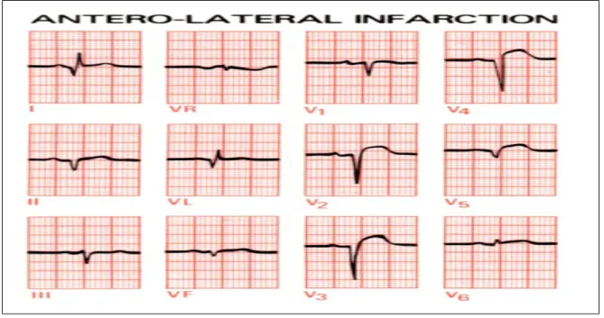 Gambar 5 : EKG menunjukkan STEMI dengan evolusi patologik Q wave di lead I dan VL