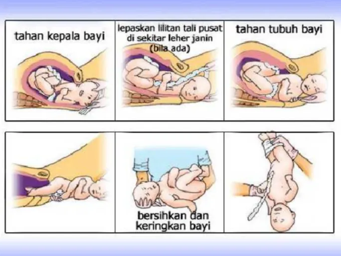 Gambar Tahap Persalinan Normal