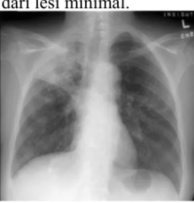 Foto rontgen thorak tuberkulosis paru