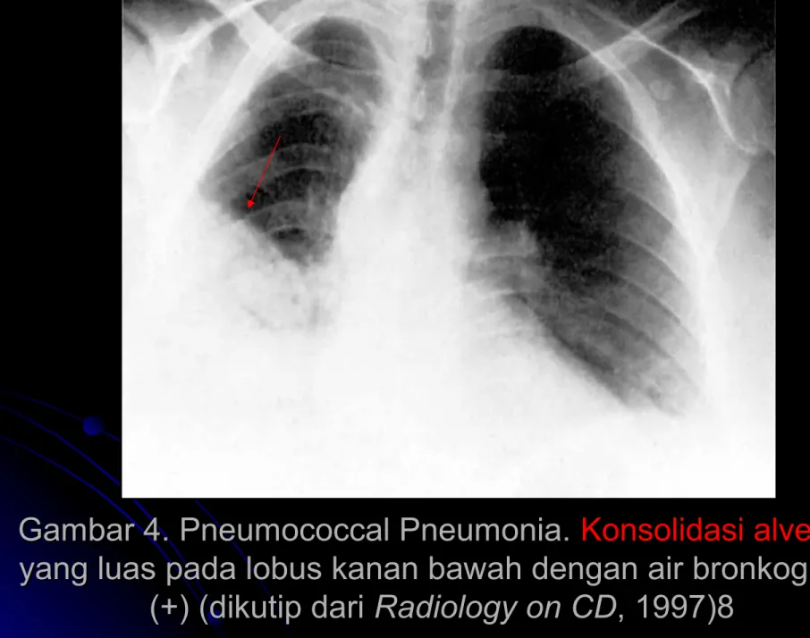 Gambar 4. Pneumococcal Pneumonia. 
