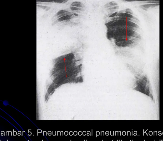 Gambar 5. Pneumococcal pneumonia. Konsolidasi pada Gambar 5. Pneumococcal pneumonia. Konsolidasi pada 
