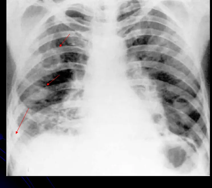 Gambar 6. Staphylococcal pneumonia dengan 