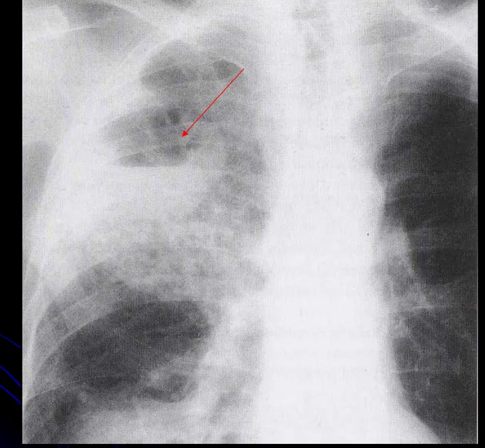 Gambar 7. Staphylococcal pneumonia pada lobus superior kanan dengan pembentukkan 