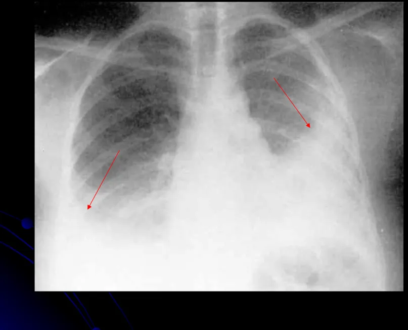 Gambar 8. Streptococcal pneumonia bilateral dan 