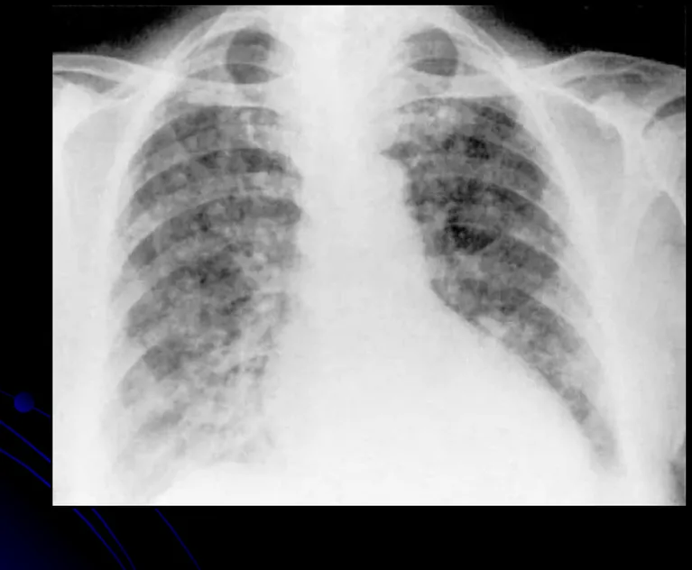 Gambar 15. Pneumonia virus dengan gambaran 