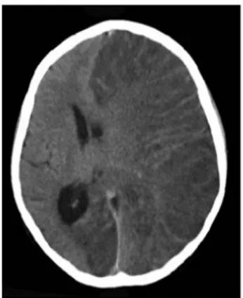 Gambar 6. CT Scan otak pada seorang gadis dengan Rasmussen's encephalitis