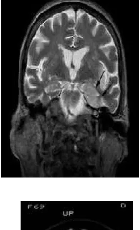 Gambar   12.   Coronal   T2   menunjukkan   citra  hyperintensity di lobus temporal kiri (panah) yang  serupa   dengan   kelainan   difus