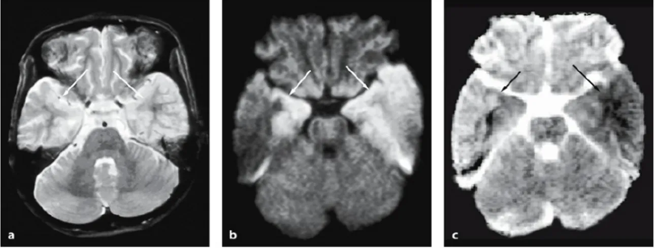 Gambar 16. Herpes simpleks tipe 1 ensefalitis pada seorang anak 11 tahun. gambar a. T2-tertimbang menunjukkan  lesi   bilateral   hyperintense   dalam  lobus   temporal   (panah)