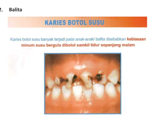 Gambar 17. Karies akibat susu botol