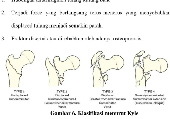 Gambar 6. Klasifikasi menurut Kyle  b.  Fraktur Subtrochanter 