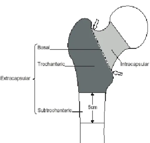 Gambar 2. Anatomi Fraktur Femur Proksimal 