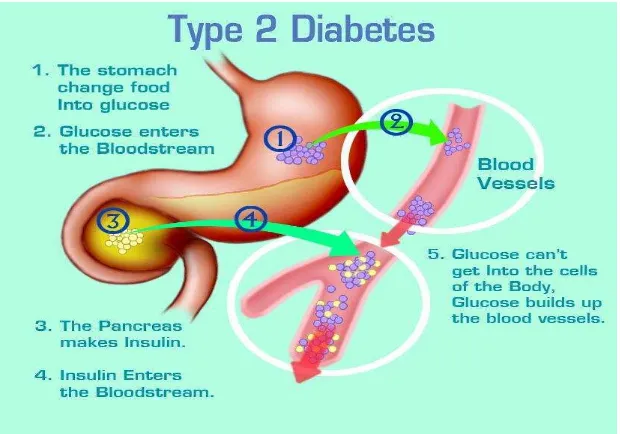 Gambar 3. Patofisiologi DM tipe 2 