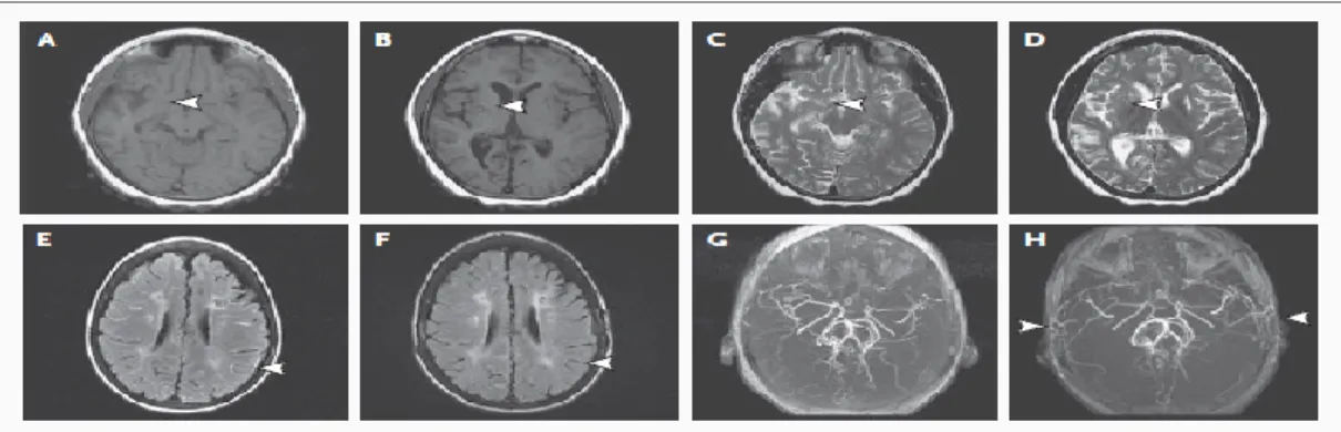 Gambar 1 : Gambaran MRI pada pasien Moyamoya 