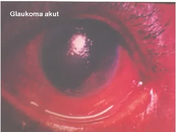 Gambar 7. Glaukoma akut 1 F. Komplikasi
