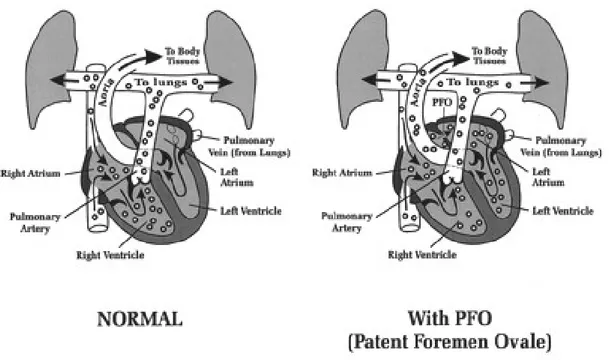 Gambar 4. Emboli gas vena pada jantung dengan patent foramen ovale
