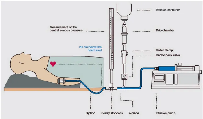Gambar  1. Infus Paralel.    Kombinasi  gravity  infusion  dan  infusion pumps  meningkatkan risiko terjadinya emboli udara, ketika gravity infusion kering