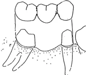Gambar 6: Extracoronal retainer 2) Partial Veneer Crown Retainer