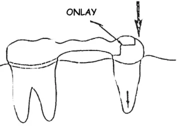 Gambar 8: Intra coronal retainer bentuk onlay 1) Dowel retainer