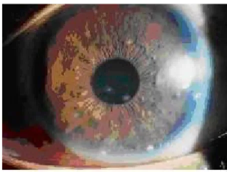 Gambar 3. Uveitis anterior granulomatosa dengan sejumlah nodul busacca  pada permukaan iris dan beberapa muttan fat keratik presipitat pada aspek inferior.