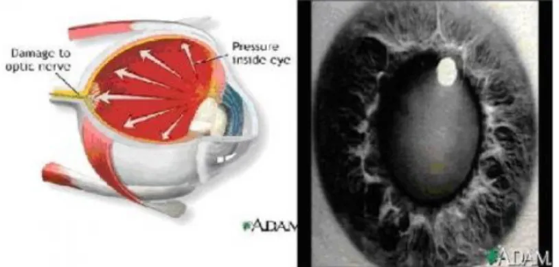 Gambar 6: Glaucoma sudut tertutup dan Katarak matur