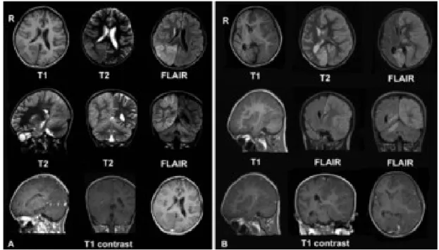 Gambar 15. MRI pasien, perempuan, 8 tahun, dengan ensefalitis Rasmussen. A. Desember 2008, pasien datang  dengan keluhan kepala dan continu epilepsia parsial