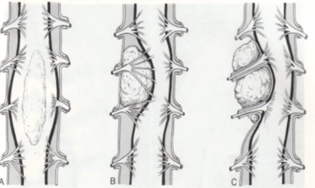 Gambar 2.1 (A) Tumor intradural-intramedular, (B) Tumor intradural- intradural-ekstramedular, dan (C) Tumor Ekstradural