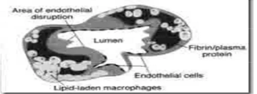 Gambar 2.4 Area kerusakan endotel (diagram skematis fotomikrograf). 18 2. Faktor Ibu